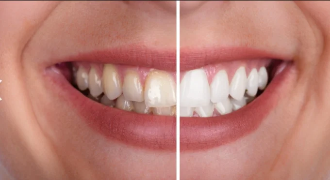 Clareamento dental