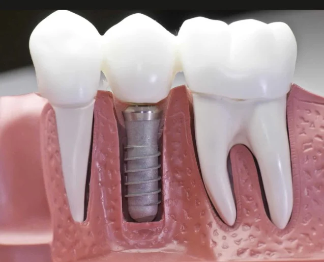 Implantes